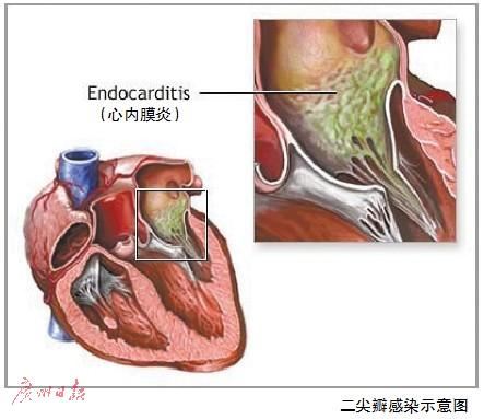 广州医生成功救孕期心内膜炎患者 为北上广首例